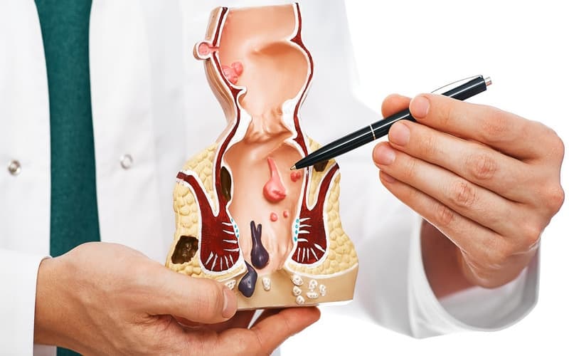 بواسیر (هموروئید) چیست؟|علائم + 3 راه درمان بواسیر
