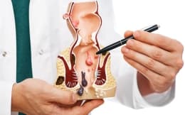 بواسیر (هموروئید) چیست؟|علائم + 3 راه درمان بواسیر