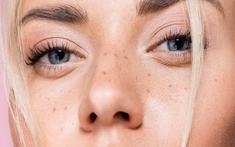 لک صورت؛ 4 بهترین روش درمان لک صورت خانگی و دارویی
