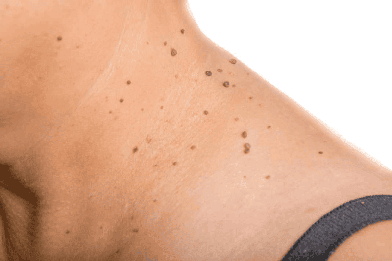 زگیل تناسلی چیست؟| علائم + بهترین راه درمان آن کدام است؟