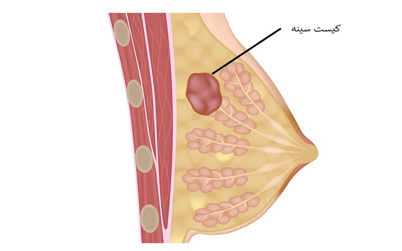انواع کیست سینه