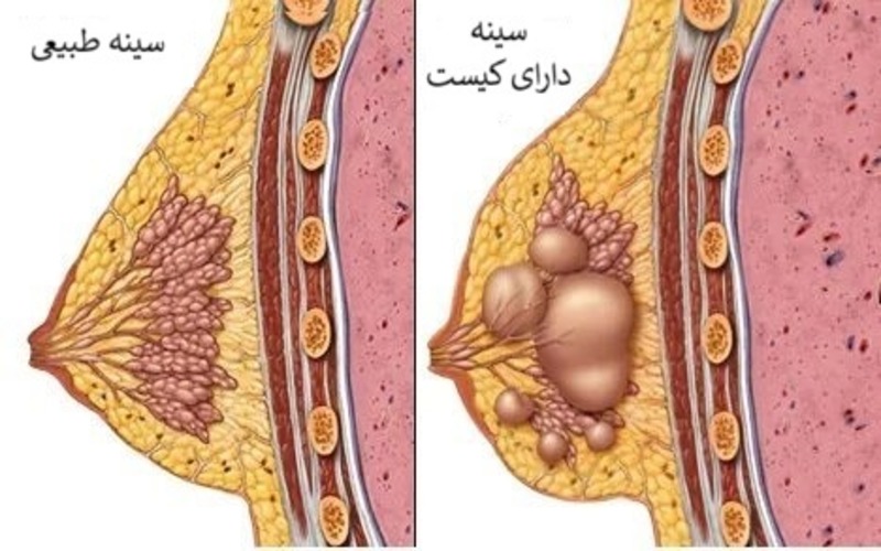 علائم کیست سینه