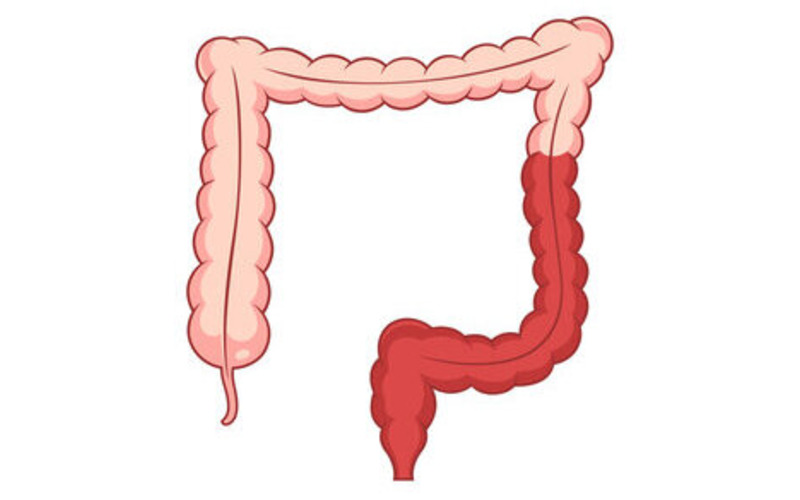 درمان کولیت