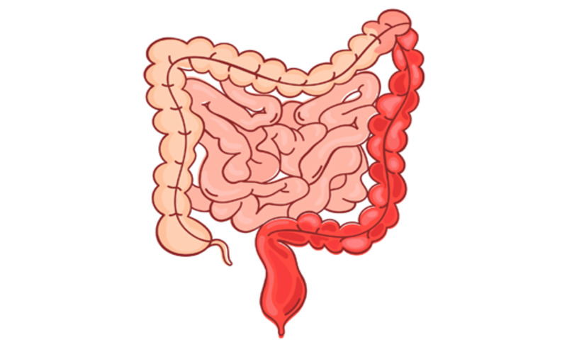 انواع کولیت روده