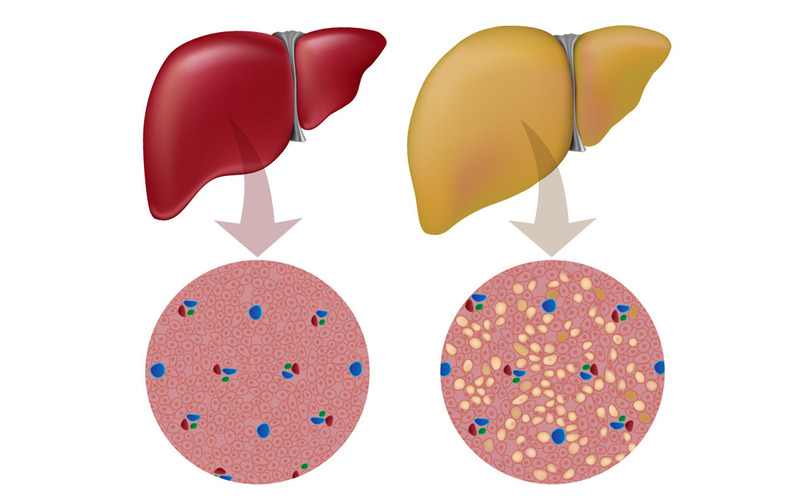 کبد چرب الکلی