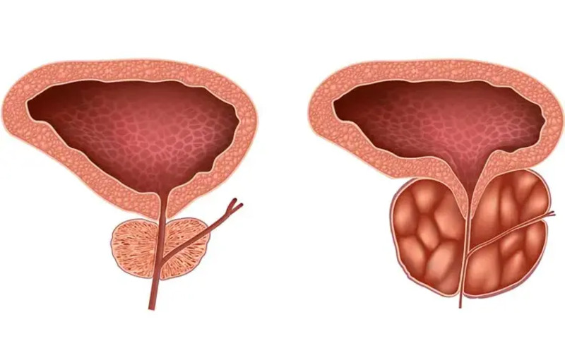 درمان بزرگی پروستات